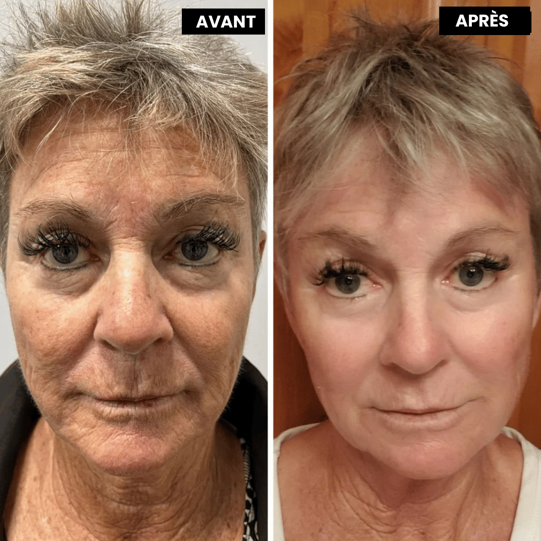 Meloria™ L’alternative nouvelle génération au rétinol