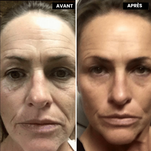 Meloria™ L’alternative nouvelle génération au rétinol