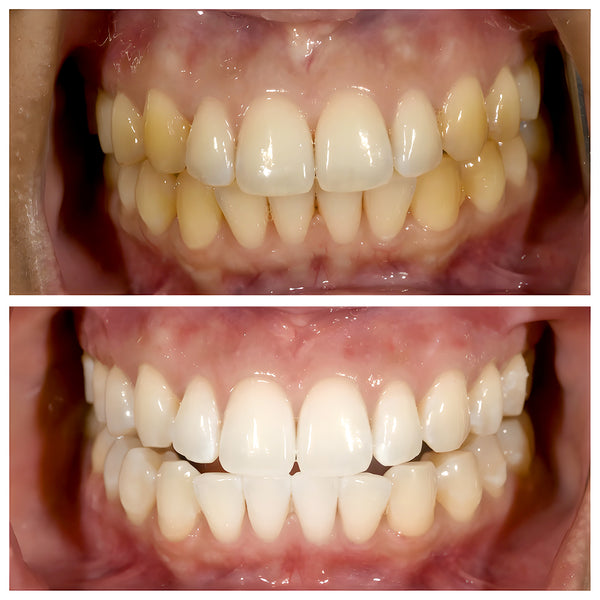 Meloria® – Dentifrice Éclaircissant à la Niacinamide